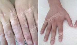 攻略:把握三点 快速治疗手脚白斑