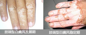 肢端型白癜风从一“愈”难求走向随心所“愈”